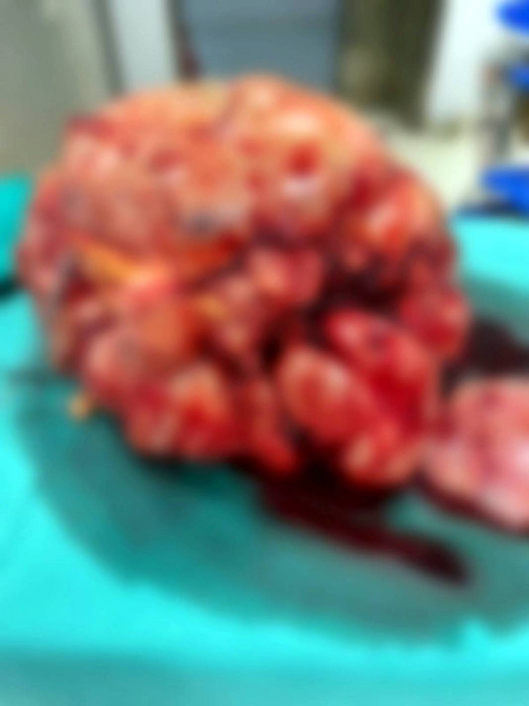 Doktor şaştı kaldı: Bu kadar büyüğünü daha önce görmedim! Hastanın karnından çıkan dev tümör şoke etti 6